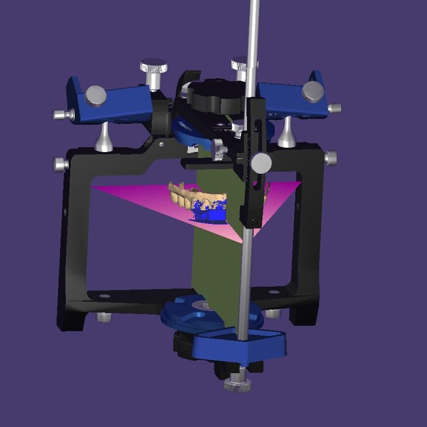 Fig. 10: Lateral view of the model orientation based on the
vertical plane of the virtual articulator.