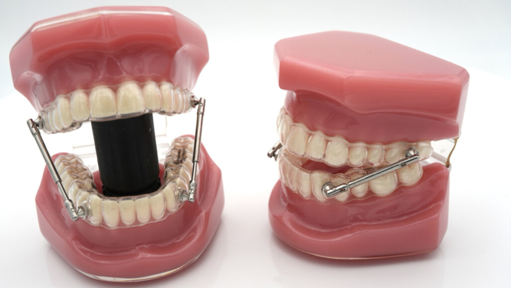 The orthocaps Rainmaker appliance: Clinical illustration and conclusions