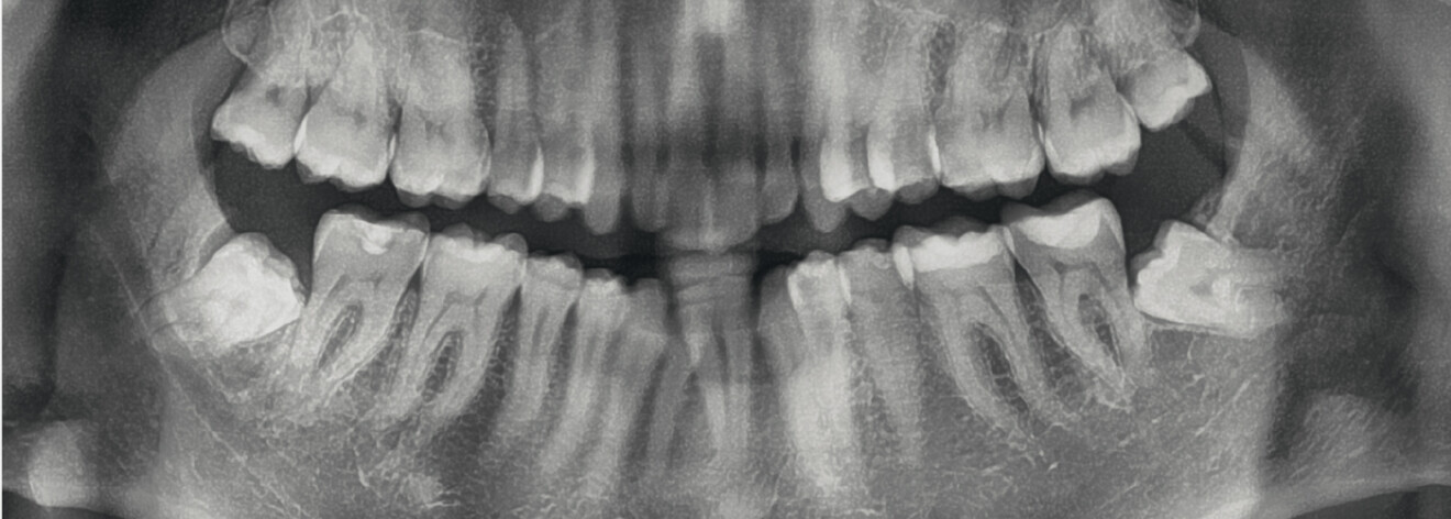 Fig. 10: Pretreatment panoramic radiograph.
