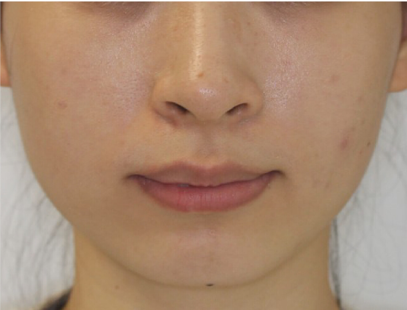 Fig. 1b: Frontal facial view. 