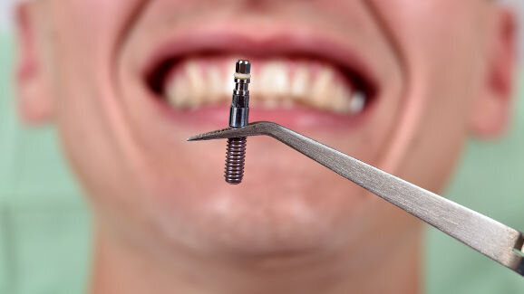 Los errores de los pacientes sobre los implantes dentales
