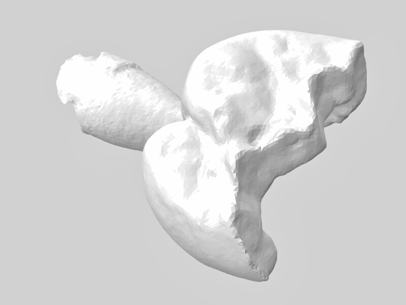 Fig. 4: STL of onlay.