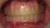 Figura 11. Cubetas precargadas en los dientes.