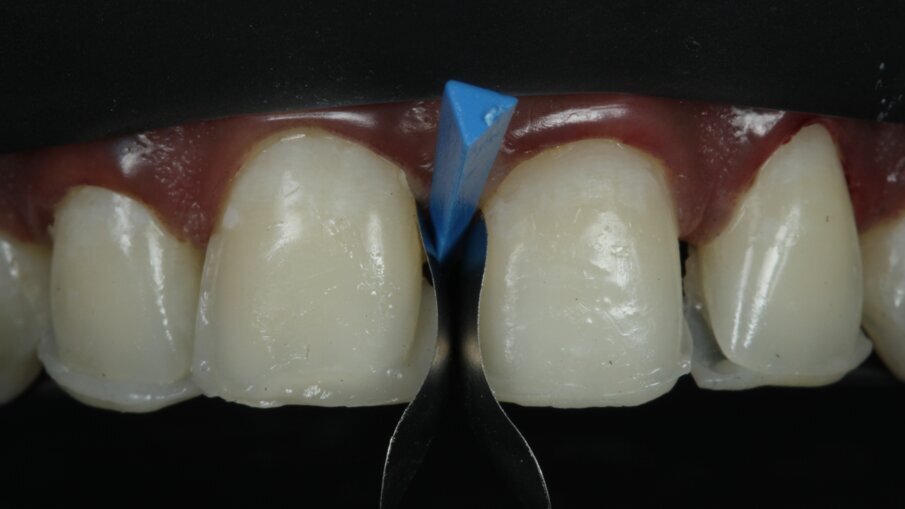 Fig 15: Matricing and Wedging
