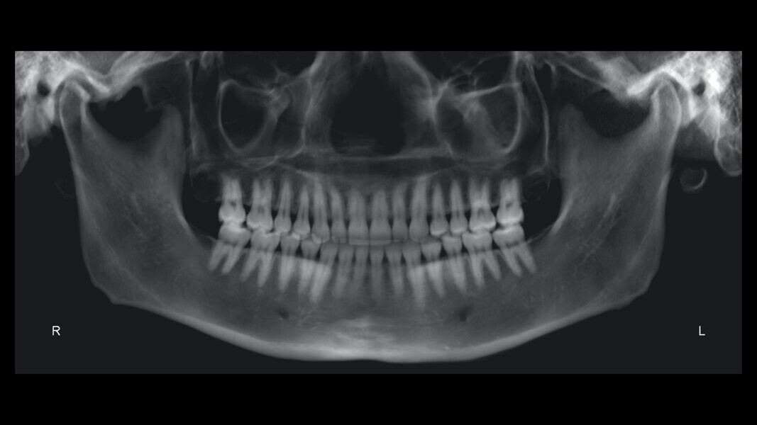 Fig. 49: Post-treatment panoramic radiograph.