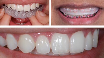 Aclaramiento dental con alineadores para Ortodoncia