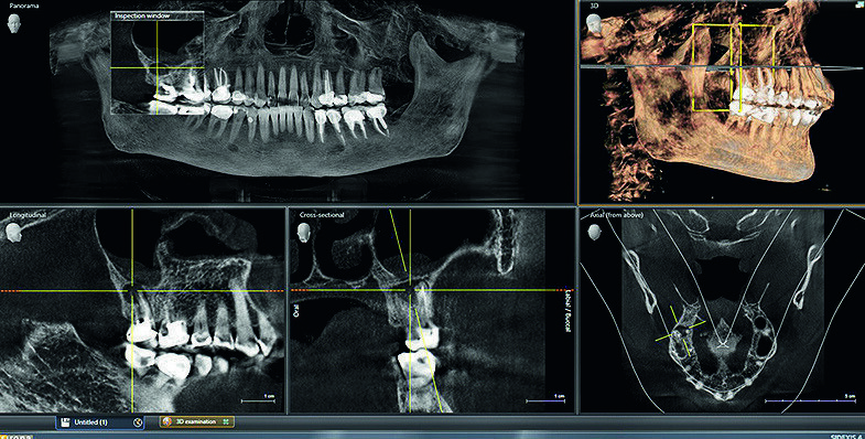 3D examination in Sidexis 4.