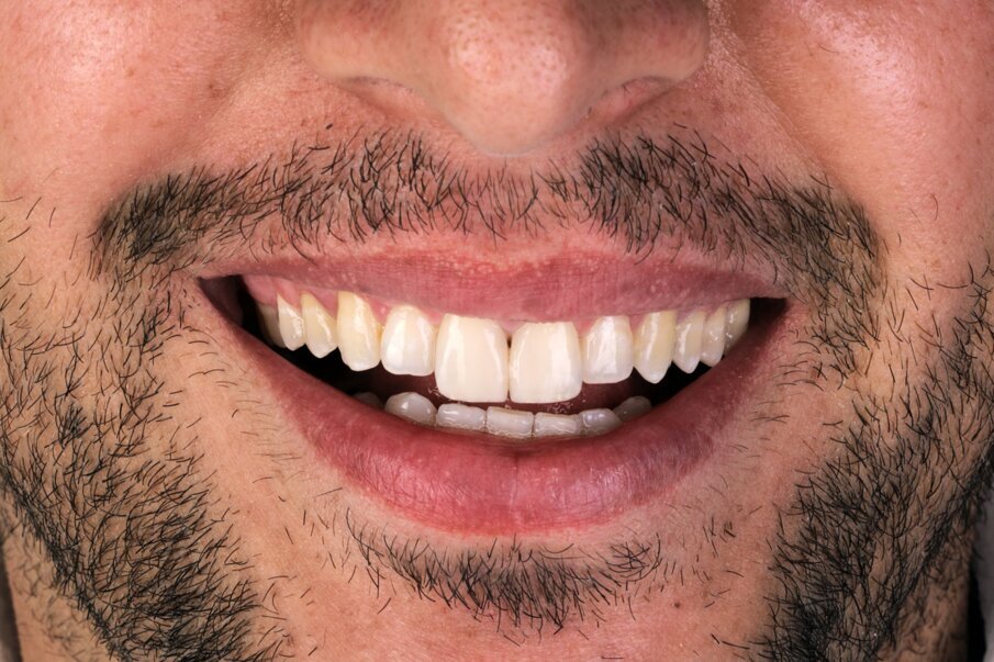 Fig. 1c: Patient’s smile after placing direct composite restorations on the upper central and lateral incisors.