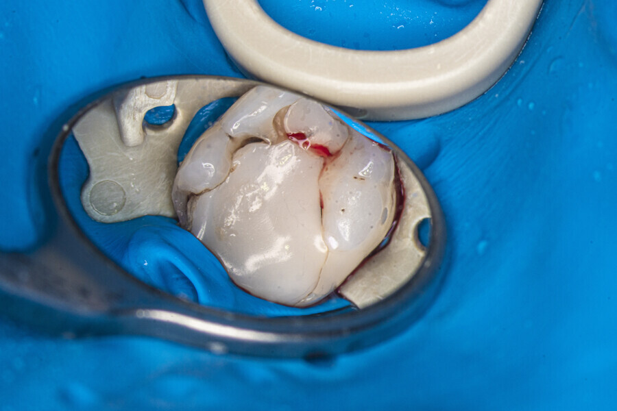 Fig. 14: Treated tooth after dental dam isolation.