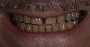 Revolutionising dental treatments: The power of digital integration with Invisalign Smile Architect