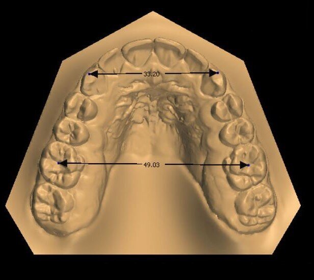 Fig. 6b_Misurazione distanza inter-molare e inter-canina a fine terapia.
