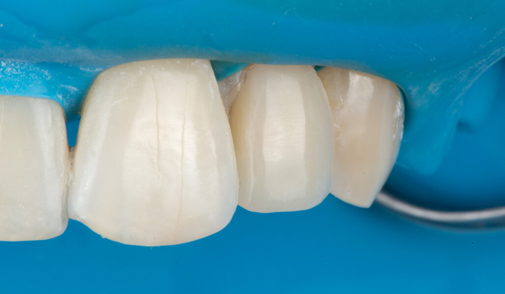 Fig. 7: Seamless integration of the composite restoration with the adjacent tooth structure.