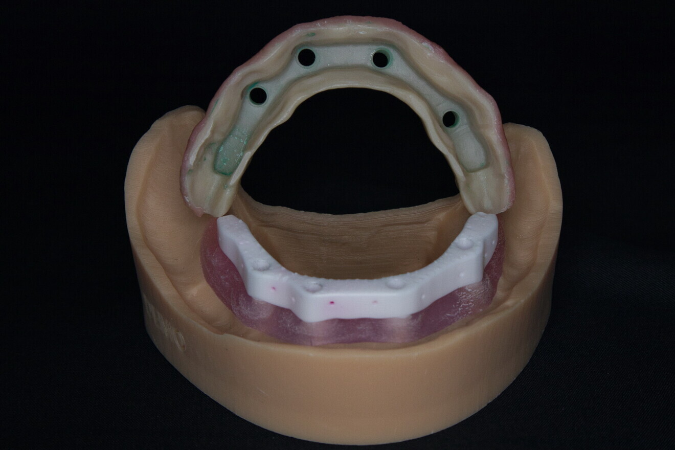 Fig. 24: Soft-tissue implant model, 3D-printed latticed zirconia implant bar and a compatible Ivotion (Ivoclar) complete mandibular denture.
