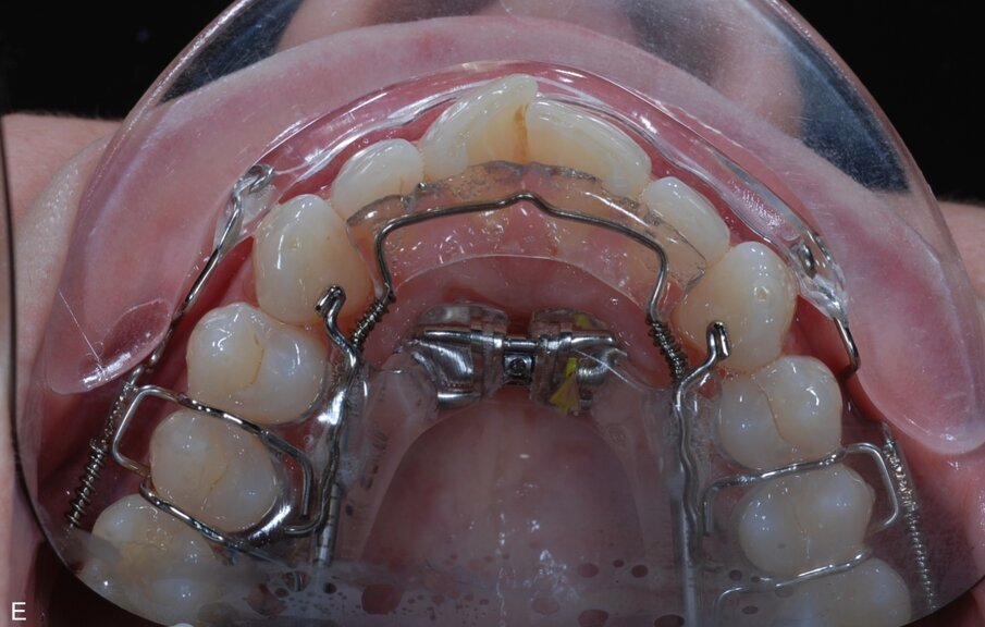 Fig. 9: ClearSmile Inman Aligner fitted