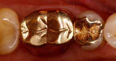 IPS Empress CAD and IPS e.max CAD LT offer aesthetics and strength