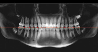 Comparison of tooth mesiodistal angulation measurements