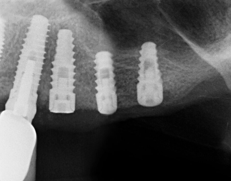 Fig. 15 - Controllo radiografico a distanza di 4 mesi dall’intervento.