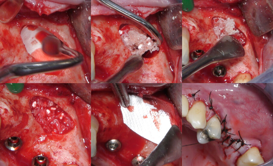Fig. 6 - Dopo avere inserito una membrana a protezione della membrana sinusale, e dopo avere riempito parzialmente la cavità col sostituto osseo, si procede al posizionamento degli impianti. Il riempimento è completato e una seconda membrana viene posizionata a copertura della finestra di accesso. La sutura è eseguita con filamento in poliammide non riassorbibile.