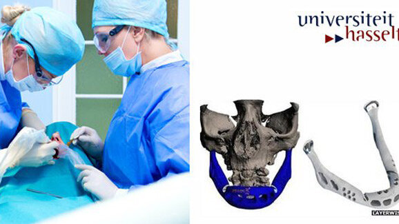 Erstes Kiefertransplantat mit 3D-Drucker hergestellt