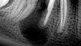 Figura 2. Lesión periapical en el diente 46 (primer molar inferior derecho) de gran tamaño. Iniciando una reabsorción radicular externa en la raíz distal.