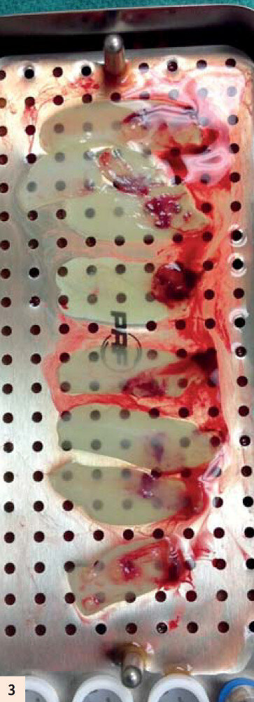 figure 3 : Membranes d’A-PRF préparées avec la PRF Box.