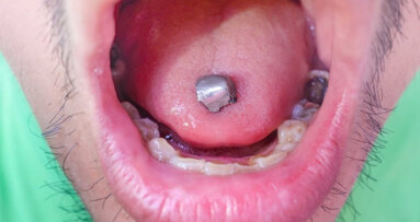 FDA mijenja stav o dentalnom amalgamu