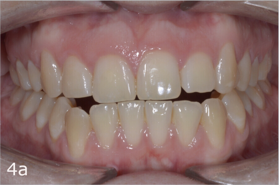 Figs. 4a–f: Class III, right subdivision canine relationship, edge-to-edge anterior bite and bilateral anterior open bite.