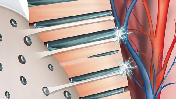 Ipersensibilità dentinale semplificata