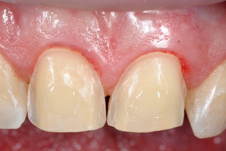 Fig. 8 A small amount of flowable composite applied to the etched surfaces.