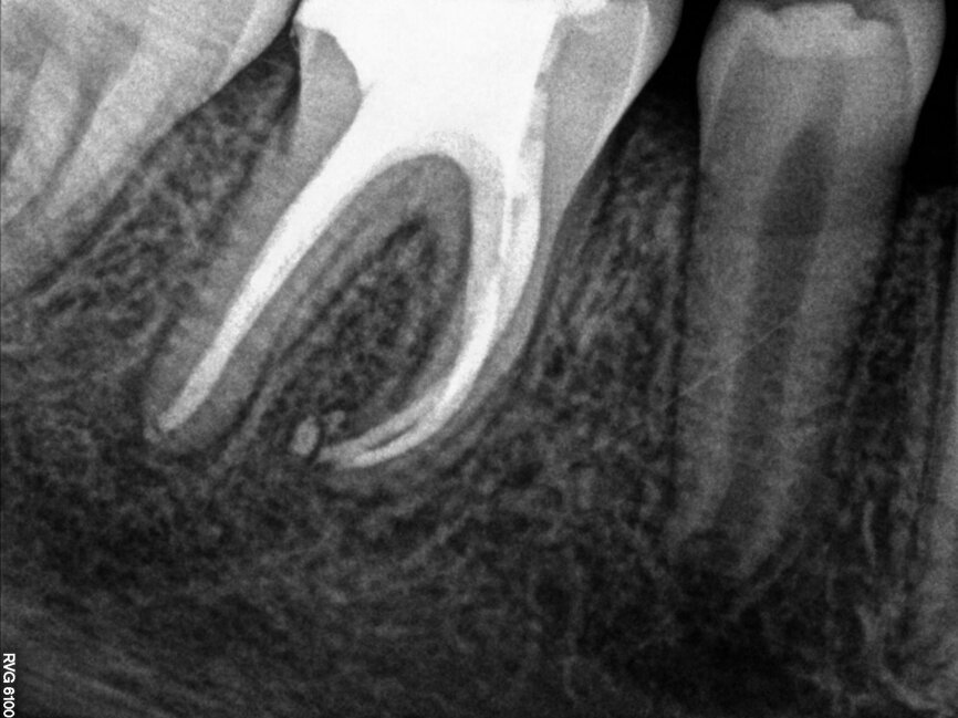 Fig. 8: Follow-up radiograph after three months showing almost complete healing.