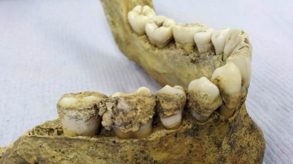 Pesquisadores encontram a primeira evidência de consumo de leite em antiga placa dental