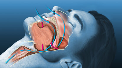 Novel application of jaw advancement surgery helps treat OSA and improves facial appearance