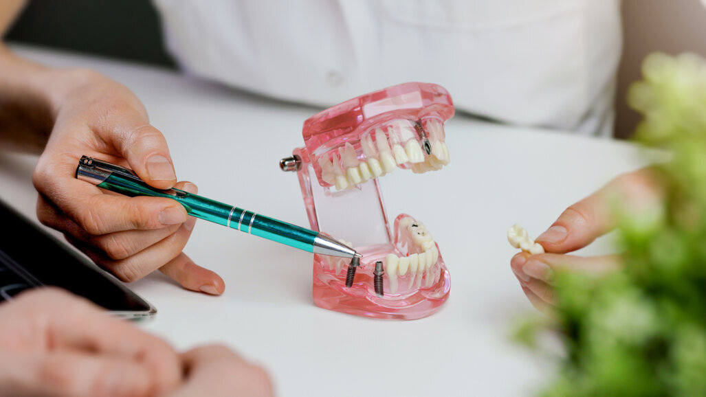 Các yếu tố vi khuẩn sớm quyết định sức khỏe quanh implant được phát hiện trong một nghiên cứu mới