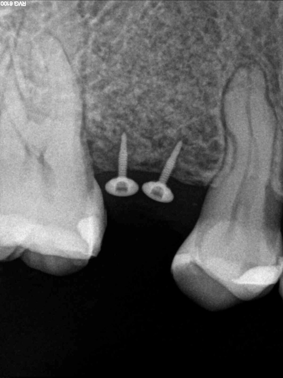 Fig. 15 - Controllo radiografico a 10 mesi.
