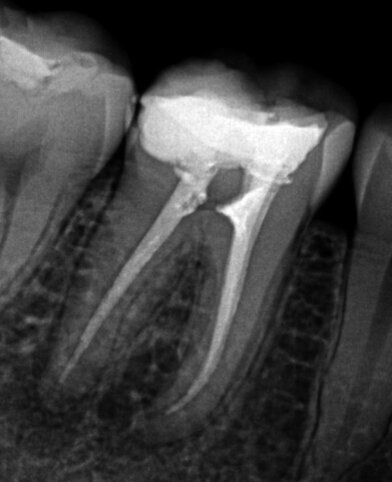 Fig. 1b: Radiograph of failed root canal treatment shown in Fig.1a.