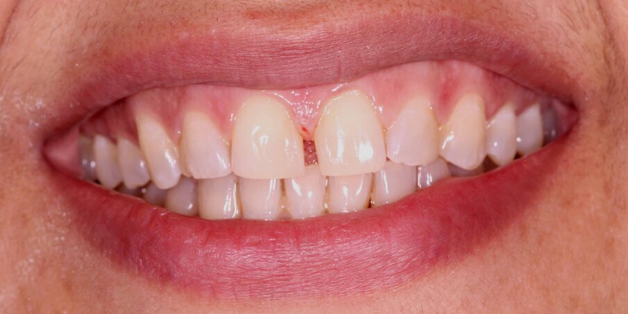 Fig 1. Initial Smile