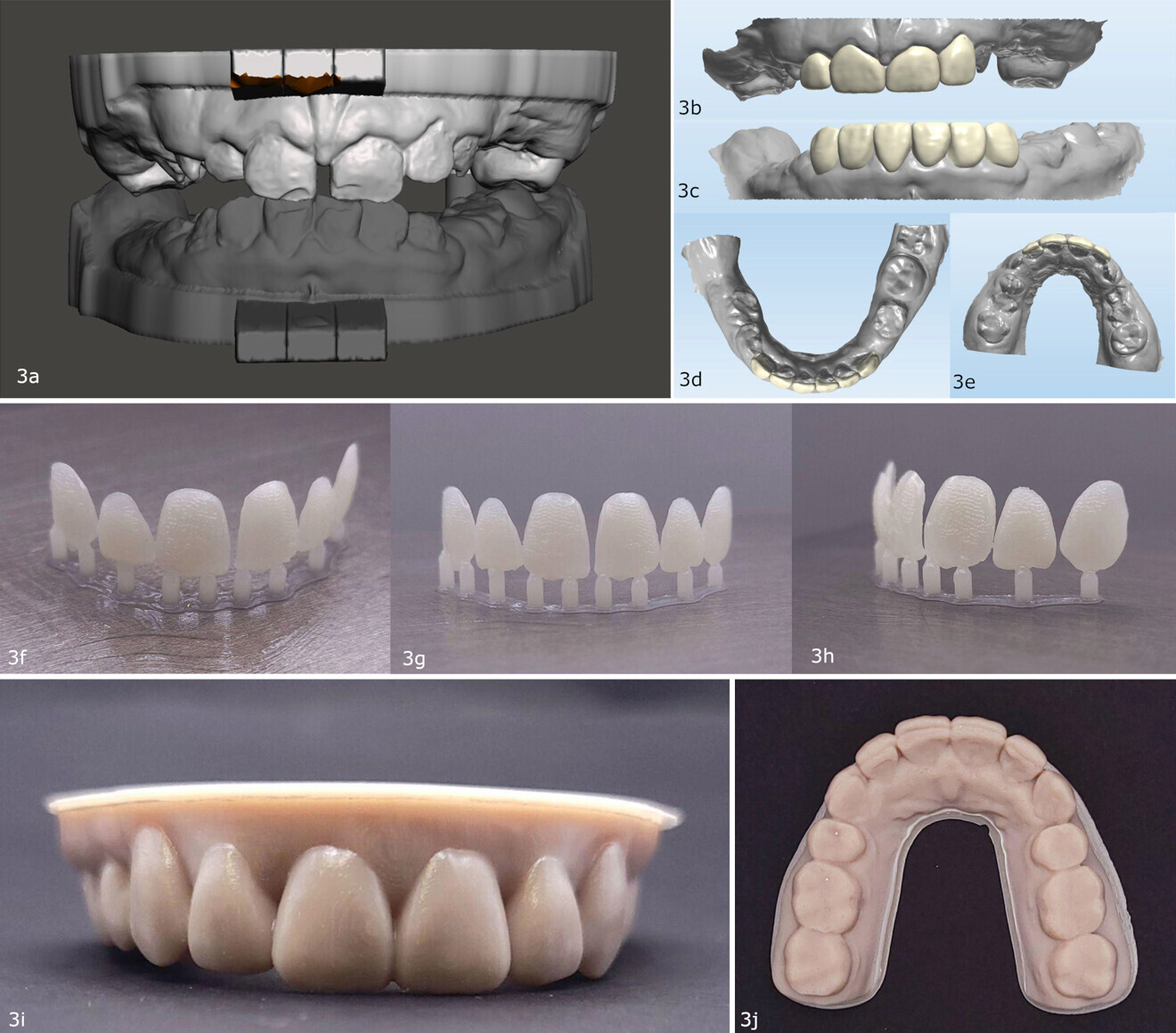 Figs. 3a–j: (a–e) Demonstration of how 3D printing can enhance the delivery of interdisciplinary care. Design of 3D-printed temporary restorations for a patient with amelogenesis imperfecta. (f–j) Mock-up veneers for a patient who completed interdisciplinary restorative and orthodontic treatment and was to receive veneers on all the maxillary anterior teeth.