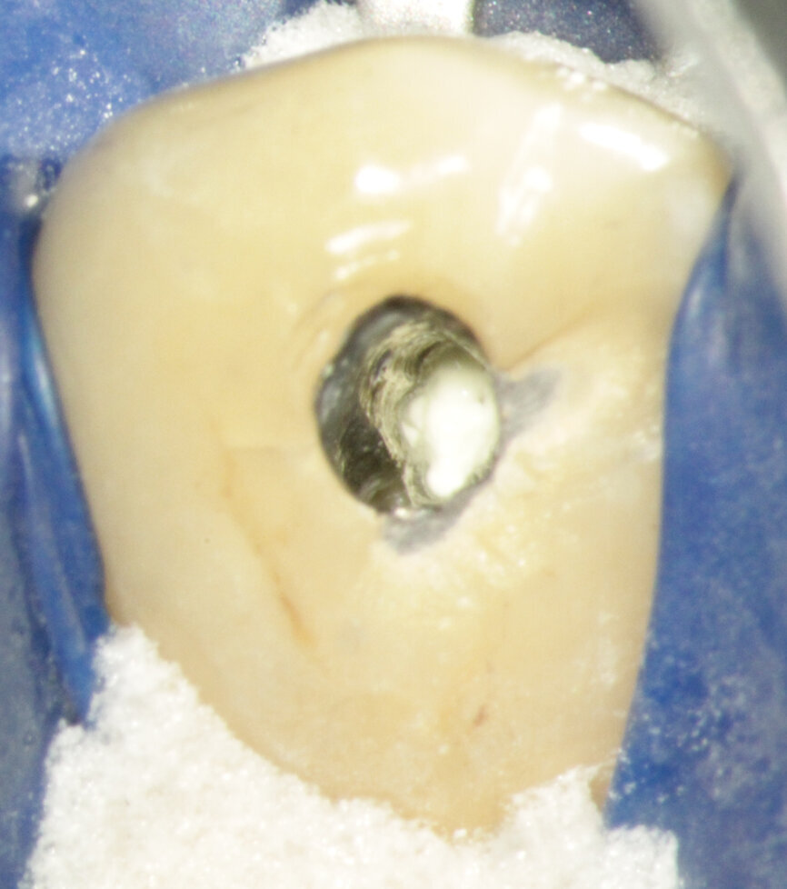 Fig. 3c: (a) Radiolucency in the cervical part of the canine. (b) Bleeding from the perforation. (c) MTA application with the MAP System and PD MTA White. (d) Original canal and repair of root perforation. (e) Post-op radiograph showing the root canal filling.
