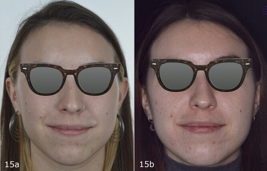 Figs. 15a–f: Extra-oral comparison of the situation (a, c & e) before and (b, d & f) after treatment. The mandibular deviation and the lower face height had been slightly corrected.
