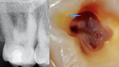 Clinical management of maxillary second molar root canal therapy in different anatomical situations
