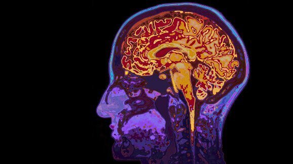 Pesquisadores encontram a relação entre bactérias orais, micro hemorragia cerebral e acidente vascular cerebral