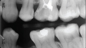 ΔΕΛΤΙΟ ΤΥΠΟΥ BiodentineTM  Βελτιωμένη κλινική εφαρμογή Ολοκληρωμένη αποκατάσταση σε μια μόνο συνεδρία