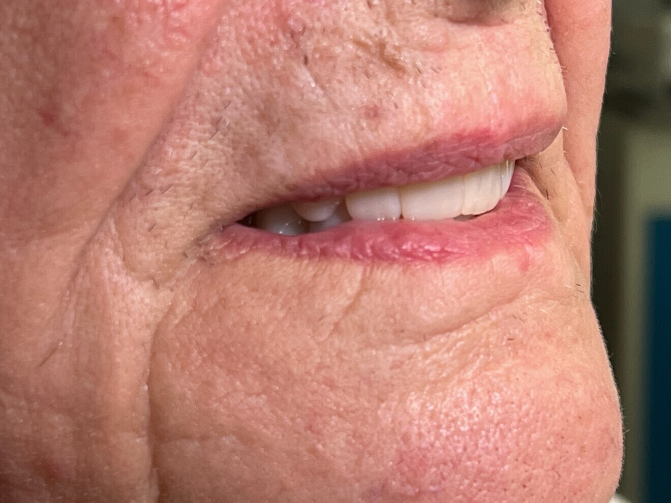 Fig. 12: Extra-oral situation at the four-week check-up.