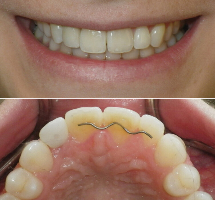 Fig.  15a and 15b. Final insertion of implant crown 12