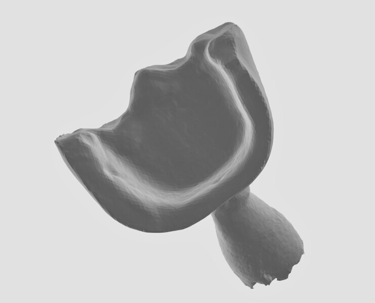 Fig. 3: STL of onlay.
