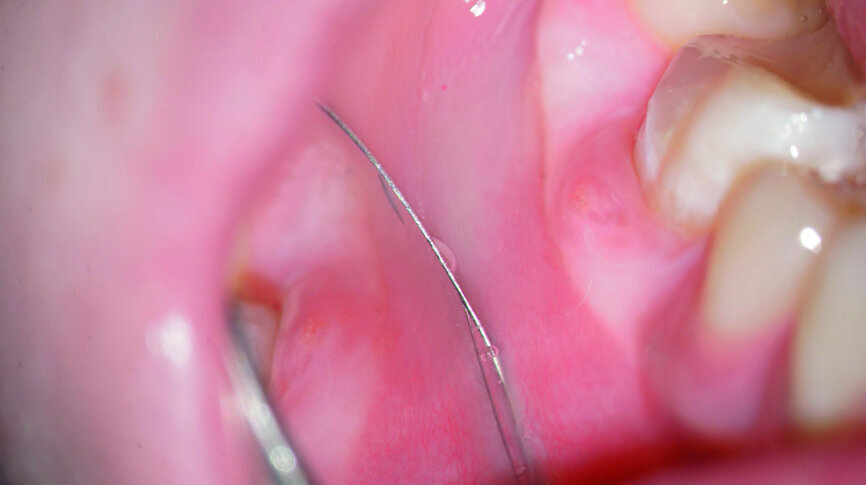 Fig. 6: Healing sinus tract at the start of the second appointment.