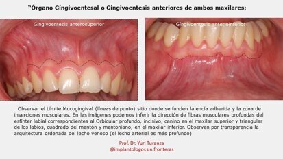 La implantología que no vemos