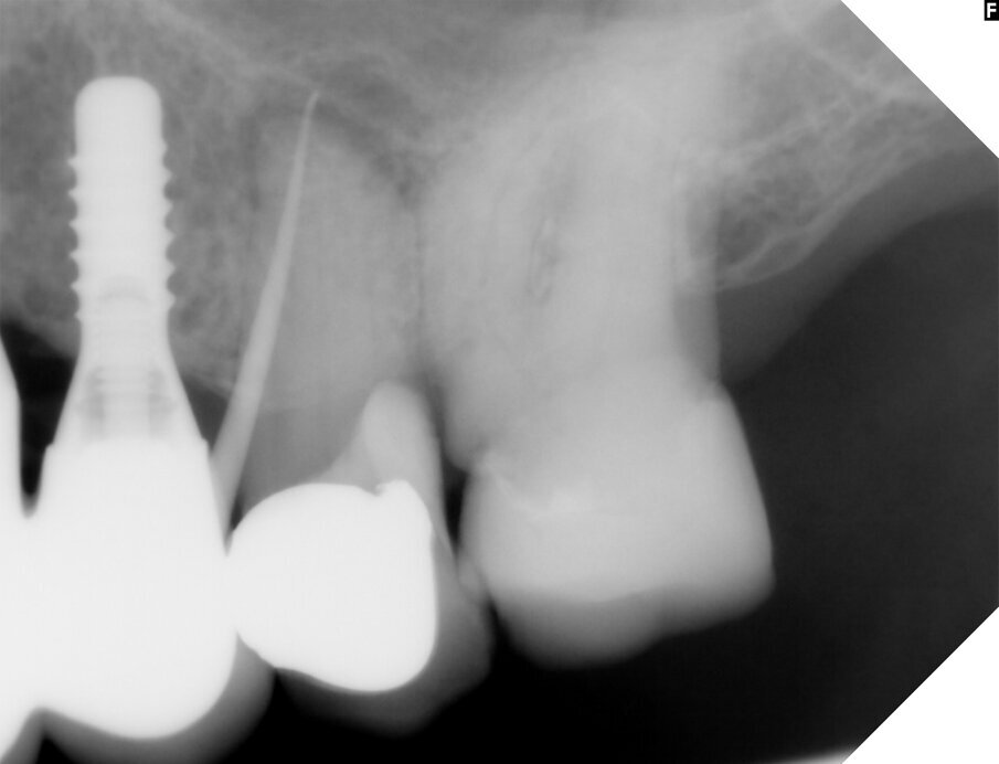 Fig. 2: Fluoroscopy by insertion of a gutta-percha point showed apical destruction as the source of infection.
