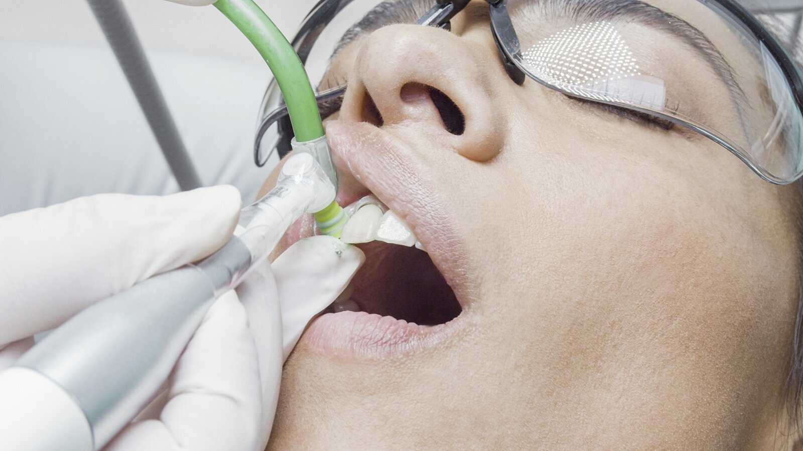 La prevención de la periimplantitis debe comenzar en la planificación de los implantes