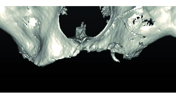 CAD/CAM custom-milled titanium bar for rehabilitation of an atrophic upper jaw